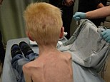 The child was taken to sanatorium where he was treated for a vast cut on his back, bumps and bruises and serious malnourishment