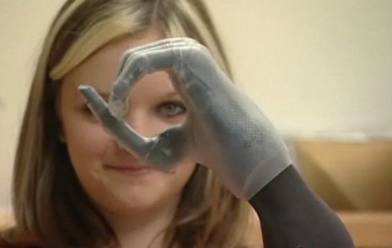chloe holmes bionic hand